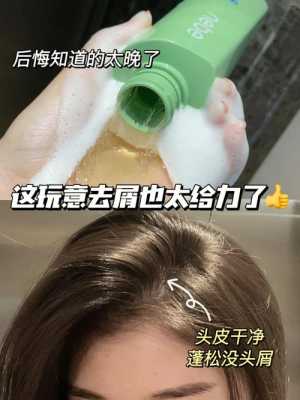 怎么能去头皮屑（怎样洗头才能把头皮屑洗掉）