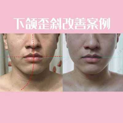 脸型不好看怎么矫正（脸不对称怎么矫正）
