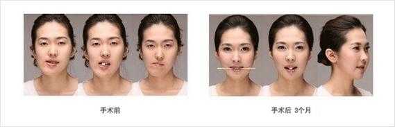 脸型不好看怎么矫正（脸不对称怎么矫正）