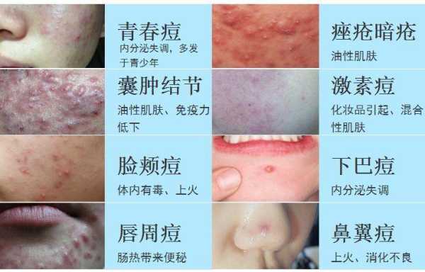 去粉刺最快的方法,怎么去粉刺最快最有效的方法