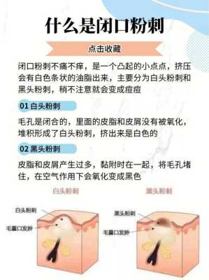 去粉刺最快的方法,怎么去粉刺最快最有效的方法