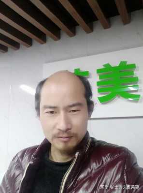 为什么男教师秃头,男的为什么会秃顶的原因