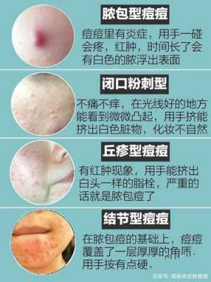 怎么样快速消除痘痘（怎么样快速消除痘痘红肿）