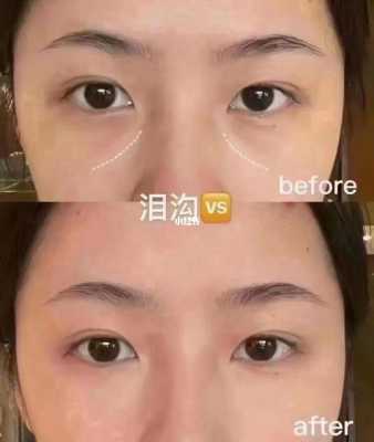 什么样的是泪沟，有图片吗,泪沟长什么样子图片大全