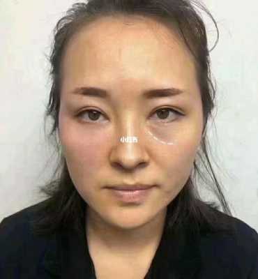 什么样的是泪沟，有图片吗,泪沟长什么样子图片大全