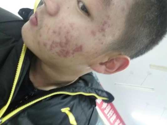 怎样快速有效的去除青春痘,男孩子长青春痘怎么解决