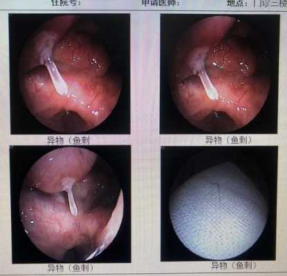 鱼刺怎么发（鱼刺怎么发制）