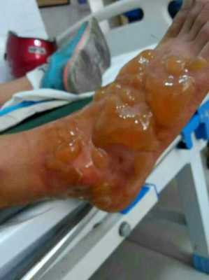 烫了怎么弄（脚让开水烫了怎么弄）