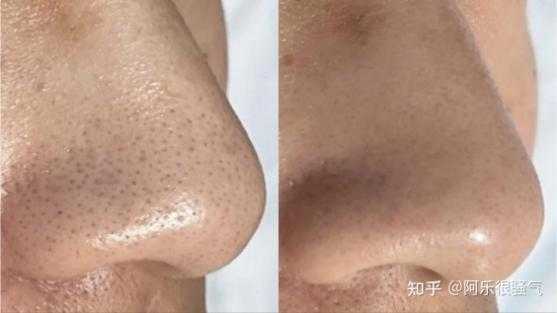 毛孔黑怎么办（毛孔黑怎么办才能变白）