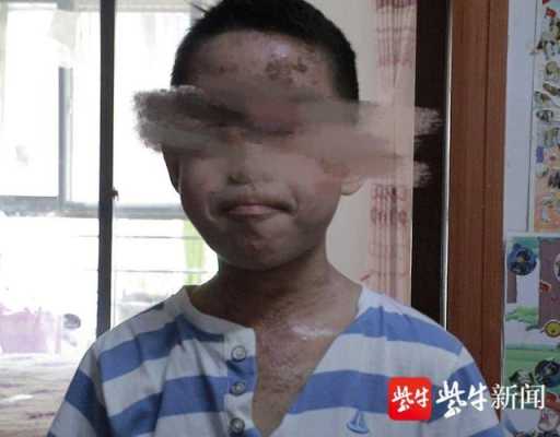 玉米男孩是什么病（玉米男孩是什么病?）