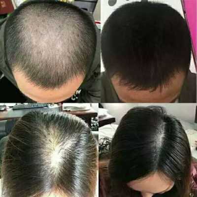 怎么防止脱发,什么东西可以防止脱发生发