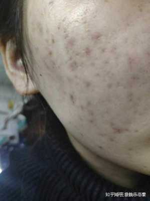 痘痘留下的黑印怎么去除像痣一样,黑痘怎么去除掉