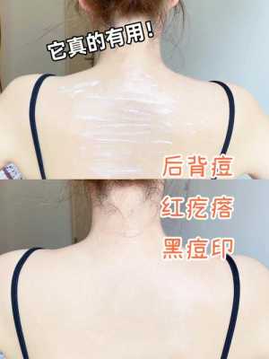 后背上的痘痘怎么去除（背部痘痘如何消除）