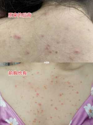 后背上的痘痘怎么去除（背部痘痘如何消除）