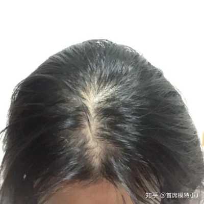 最近掉挺多新长出的细小的头发怎么回事,初中女生掉头发严重是什么原因