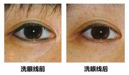 眼角纹怎么去除,怎么样去除眼角纹眼线