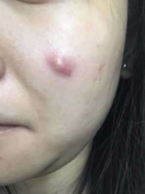 脸上起痤疮怎么治疗（脸上起痤疮怎么治疗最有效）