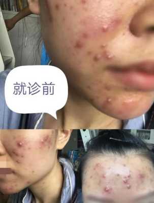 脸上起痤疮怎么治疗（脸上起痤疮怎么治疗最有效）