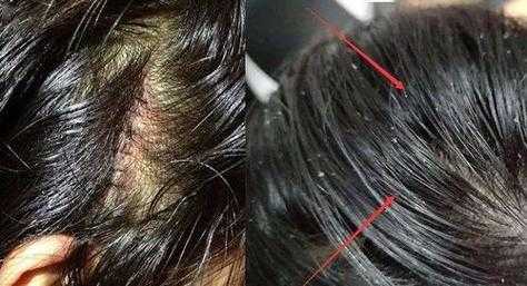 头屑多掉发怎么办（头屑多掉发怎么办怎么治疗）
