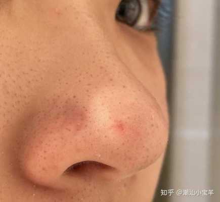 鼻子上有很多黑头怎么办（鼻子上有很多黑头怎么办图片）