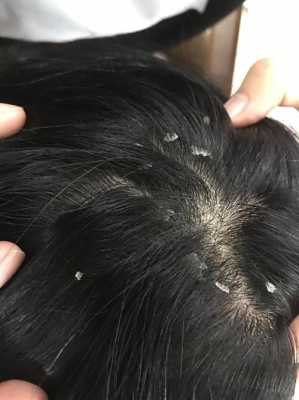 男士头皮屑多是什么原因,老年人头皮屑多是什么原因男
