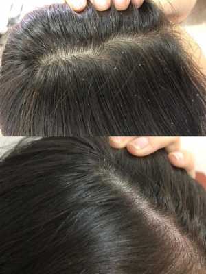 头皮屑多是什么发质（头皮屑多是什么发质的原因）