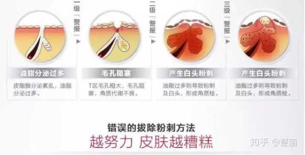 白头怎么去掉（怎样去除脸上的白头）