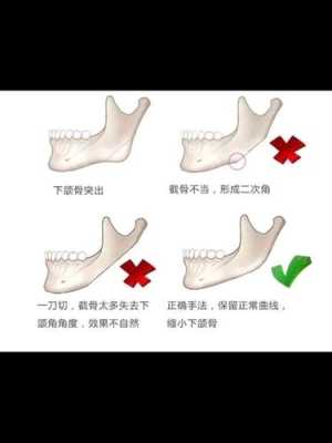 什么是颚骨宽（颚骨宽怎么办）