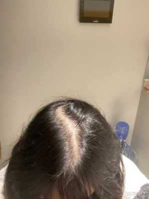 头发比较稀疏怎么办（头发比较稀疏怎么办女生）