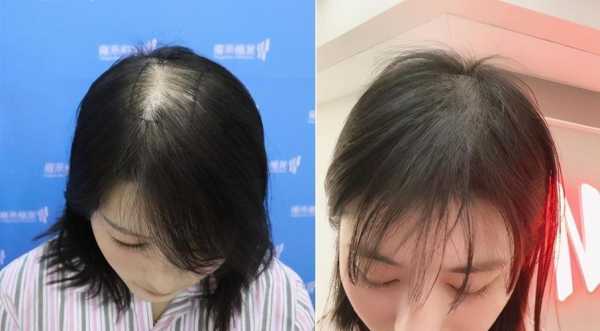 头发比较稀疏怎么办（头发比较稀疏怎么办女生）
