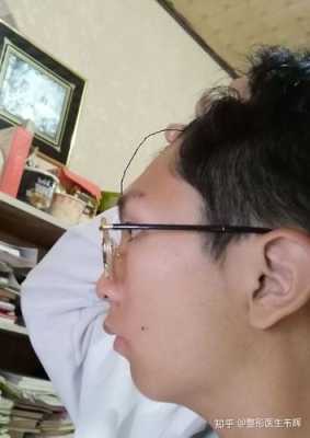 凸额头怎么办（凸额头能整平吗）