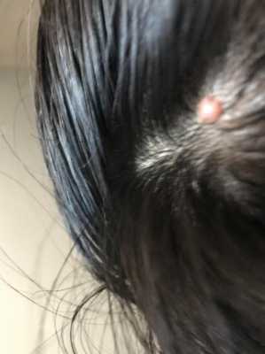 头皮上长疙瘩是什么原因（上火头皮上长疙瘩是什么原因）