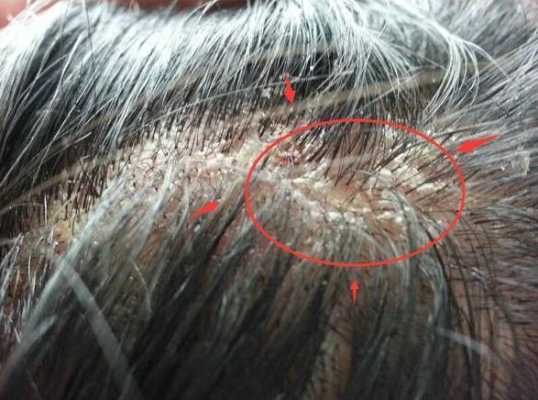 头皮上长疙瘩是什么原因（上火头皮上长疙瘩是什么原因）