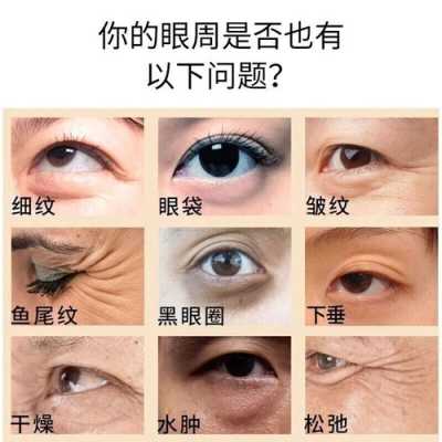 眼角皱纹怎么改善,怎么样去除眼角皱纹最有效