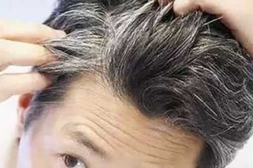 为什么会有青少年有白头发,青少年为什么有白头发,怎样治