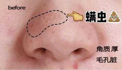 脸上很多黑头怎么办,好多黑头怎么办才能去除