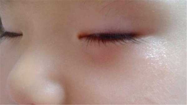 孩子的眼袋很大有点肿，是怎么回事呢,眼袋很大是怎么回事啊