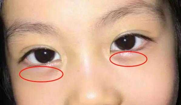 孩子的眼袋很大有点肿，是怎么回事呢,眼袋很大是怎么回事啊
