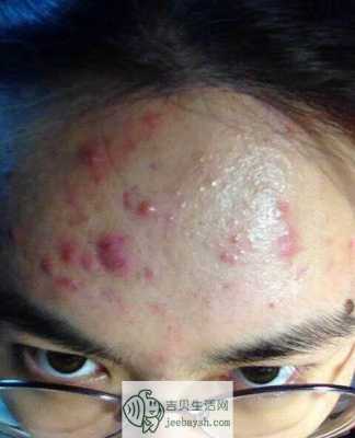 额头长痤疮怎么治疗（额头长痤疮怎么治疗最好）