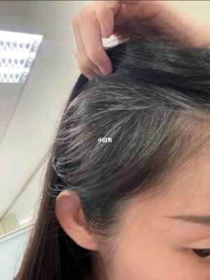 头发发白怎么治（头发发白怎么治疗）