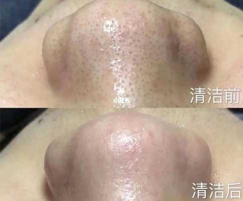 头皮毛囊堵塞怎么清洗,毛孔堵塞了怎么清理干净
