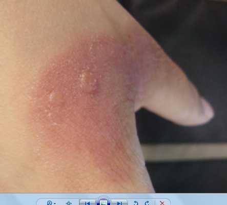 手被夹板烫了怎么办（手被夹板烫了怎么办出了水泡）