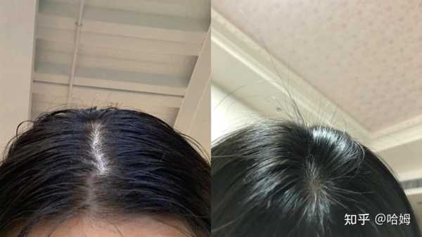 头发油腻掉发怎么办（头油掉发严重怎么改善）