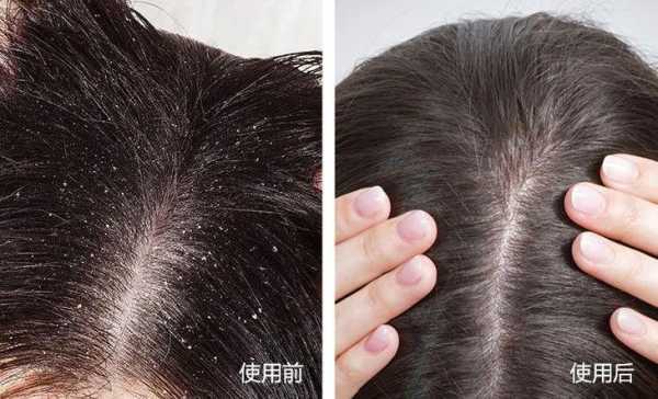 头痒头屑多怎么办,头皮越抓越痒头屑越来越多