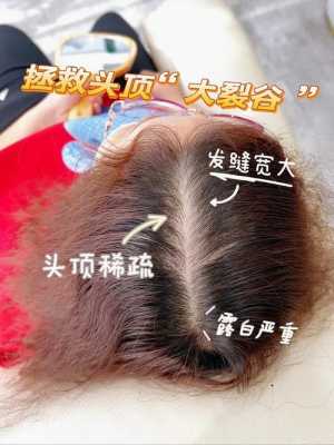 头发掉的好厉害怎么办（头发掉的厉害怎么治）