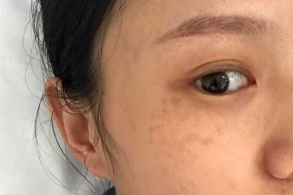 妊娠斑吃什么能去掉,孕斑怎样才能消除掉