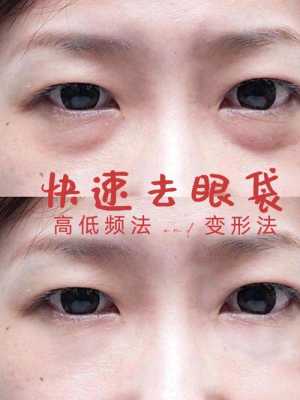 眼袋大怎么去（眼袋很严重，如何消除眼袋）