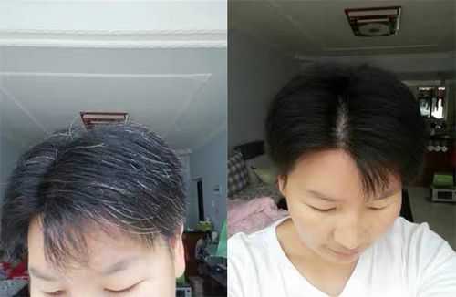 我是一名中学生，有很多白发，怎么办,青少年长白发怎么改善