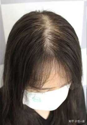 女孩头发少怎么办（女孩子头发稀少怎么办）
