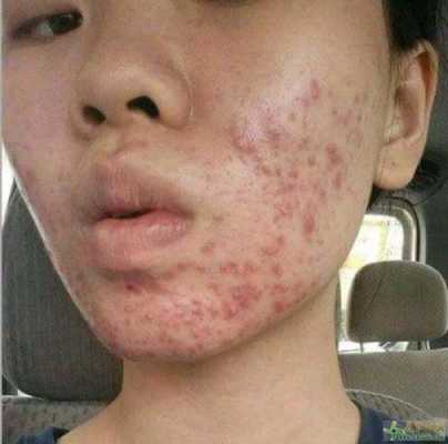 脸上突然长痘痘怎么办,脸上怎么去粉刺痘痘